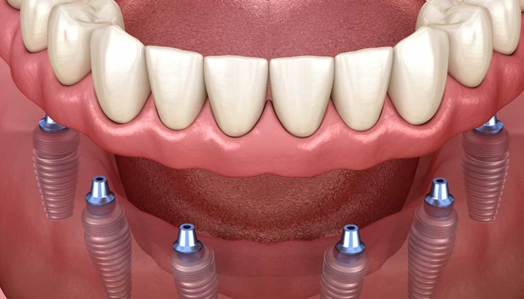 4.6 зуб в стоматологии