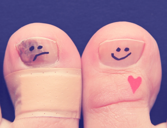 Жировики у ребенка: почему появляются и как убрать Слоятся и ломаются ногти на ногах: причины и как с этим бороться?