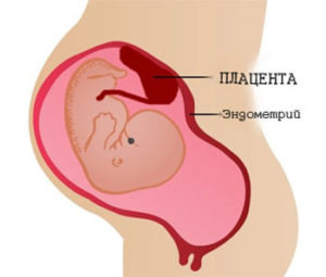 Как протекает беременность после лечения эндометриоза?