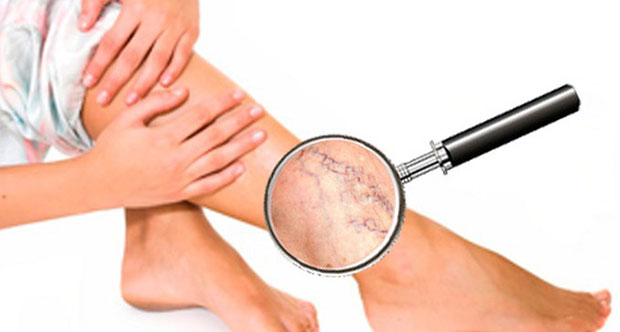 Какие виды операций проводятся при варикозе, и как проходит послеоперационный период Какие виды операций проводятся при варикозе, и как проходит послеоперационный период