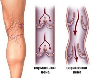Варикозное расширение вен на ногах при беременности: симптомы и лечение