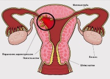  Эндометриоз матки при климаксе: симптомы и лечение