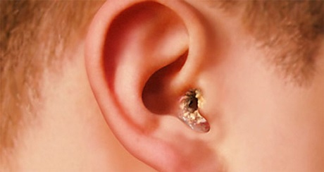 Симптомы себореи в ушах, фото
