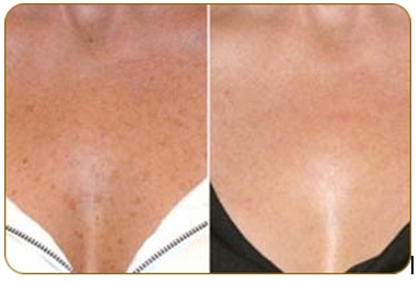 Фракционное омоложение кожи лица: фото до и после