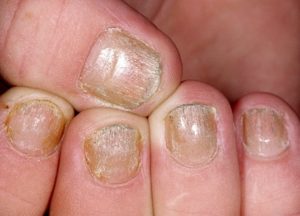 Отличие лечения псориаза на ногтях, на голове, лице и теле
