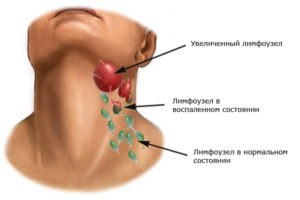 Как определить увеличение лимфоузлов на шее?