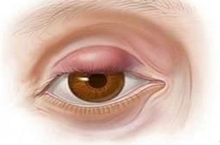 Лечение ячменя на глазу домашними и аптечными средствами Лечение ячменя на глазу домашними и аптечными средствами