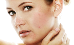 Угревая сыпь на спине и лице: из-за чего возникает, как лечить дома Угревая сыпь на спине и лице: из-за чего возникает, как лечить дома