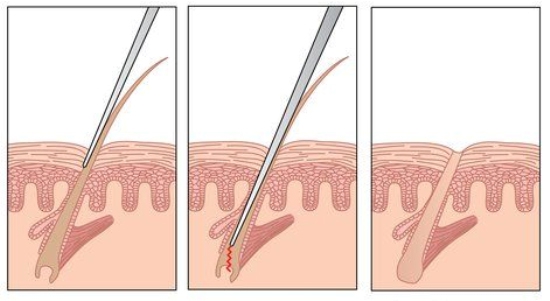 Как происходит процедура на лице, ногах, зоне бикини и подмышек