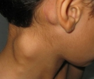 Как выглядят увеличенные лимфоузлы на шее у ребенка и взрослого, причины их возникновения и лечение
