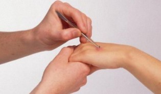 Вытаскиваем занозу из под ногтя и пальца: как это правильно сделать, и на что обратить внимание Вытаскиваем занозу из под ногтя и пальца: как это правильно сделать, и на что обратить внимание