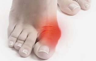 Причины появления косточек на ногах, и методы избавления от них Причины появления косточек на ногах, и методы избавления от них