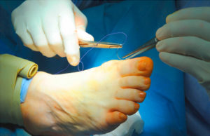 Виды операций по удалению «косточек» на ногах