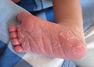 Шелушится кожа на ногах ребенка: причины