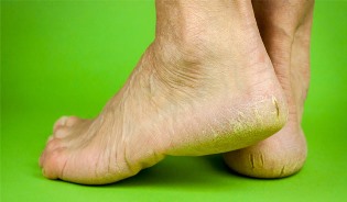 Что способствует появлению трещин на пятках, и методы лечения заболевания Что способствует появлению трещин на пятках, и методы лечения заболевания