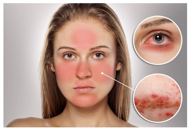 Некрасивое красное лицо — определяем причины и лечение Некрасивое красное лицо