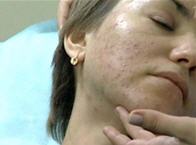 Поздние акне у женщин