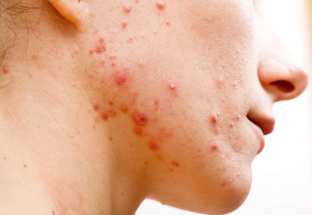 Розовые угри на лице: фото, причины и лечение