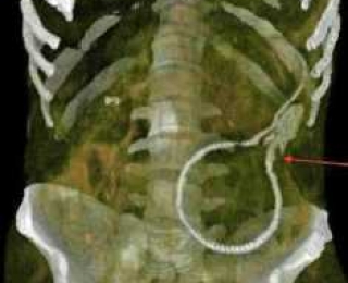 Стадии сифилиса: первая (ранняя), вторая и третья.