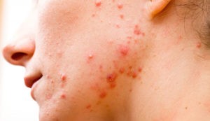 Как лечить акне на лице – препараты, схема лечения, методы