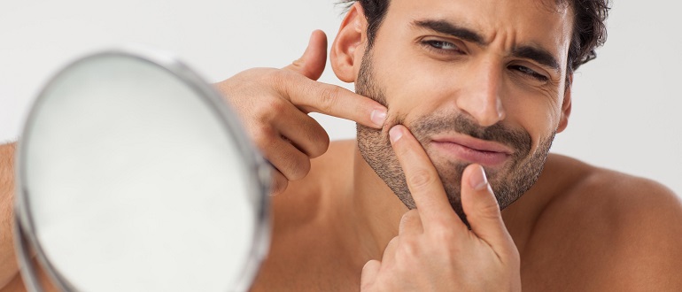 Акне у мужчин: лечение, причины, симптомы (фото)