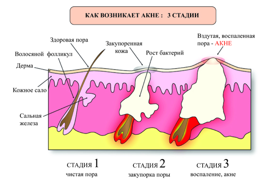 Что такое акне? Фото на лице, лечение у взрослых и новорожденных, Кожные заболевания