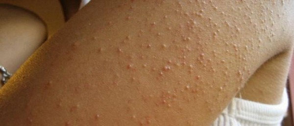 Прыщи на ногах у женщин и мужчин: причины, почему чешутся ноги и появляются пупырышки