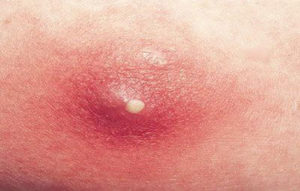 Красные прыщи на лице у взрослого: причины появления по телу и лицу, что делать, если чешутся и как быстро от них избавиться в домашних условиях