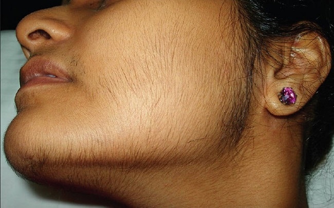 Гирсутизм у женщин: 10 полезных советов по лечению