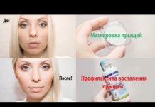 Прыщи на подбородке у женщин, лечение * Какой орган не в порядке