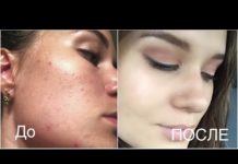 Прыщи на подбородке и шее у женщин, причины и лечение