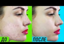 Как избавиться от прыща за одну ночь? Проверенные методы для всех