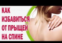 Почему на спине появляются прыщи и как быстро от них избавиться