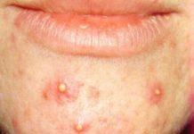 Гнойные прыщи на лице причины и лечение, как убрать и избавится