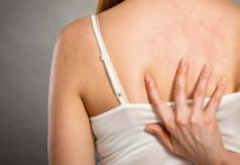 Прыщи на спине у женщин — причины и лечение — Про прыщи