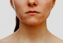 Прыщи на грудине у женщин: причины