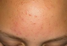 После родов прыщи на подбородке и угревая сыпь на попе