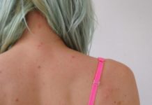 Прыщи на плечах у женщины и причины их появления на спине