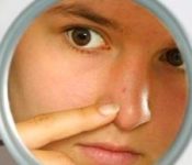 Прыщи на подбородке, носу и лбу, причины возникновения — Польза и вред для организма человека