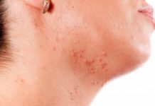 Прыщи на шее у женщин причина, высыпания под челюстью, мелки, белые угри, от чего появляются