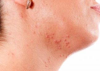 Прыщи на шее у женщин причина, высыпания под челюстью, мелки, белые угри, от чего появляются