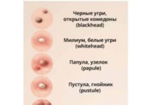 Сыпь на грудине в виде прыщиков у женщин: мелкие, белые, красные, гнойные, подкожные прыщики