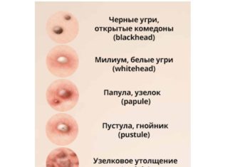 Сыпь на грудине в виде прыщиков у женщин: мелкие, белые, красные, гнойные, подкожные прыщики
