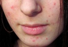 Почему появляются прыщи на лице у женщин после 30-35 лет и как с ними бороться — на