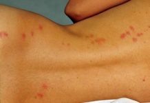 Прыщи на спине и плечах у женщины: причины появления, как избавиться