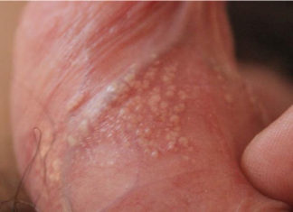 Прыщи на половых органах: чем они вызваны и как их лечить — На коже