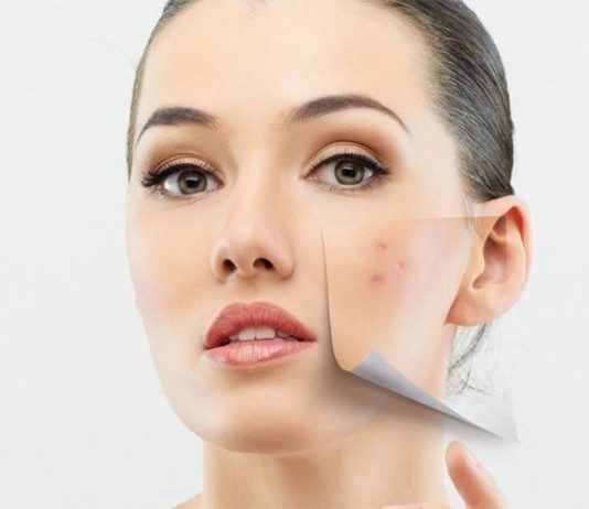 Подкожные прыщи на лице и подбородке как шишки: как избавиться