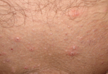 Гнойные прыщи на лобке у мужчин и женщин: фото, причины и лечение