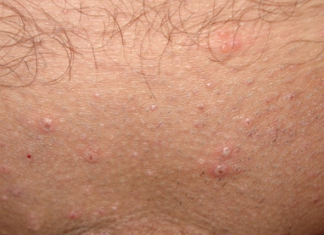 Гнойные прыщи на лобке у мужчин и женщин: фото, причины и лечение