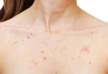Прыщи на грудине у женщин — фото, причины и как избавиться